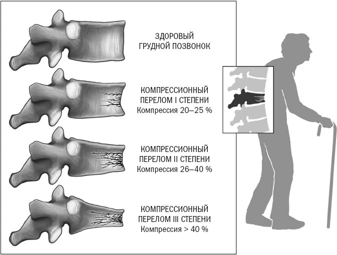 Компрессионный перелом грудного отдела позвоночника степени Компрессионный перелом грудного отдела позвоночника степени